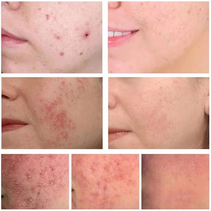Bitkisel Sivilce Giderici Yüz  - Skincare Herbal incelemesi ve fiyatı